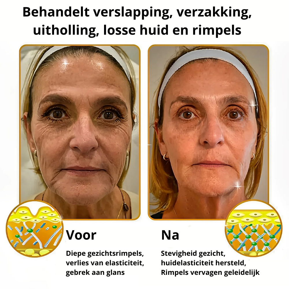 BOTOX
